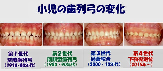小児の歯列弓の変化：第1世代〜第4世代