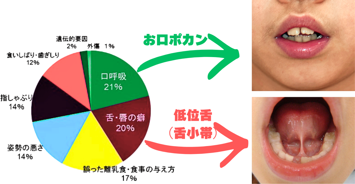悪い歯ならびの原因の円グラフと症例写真