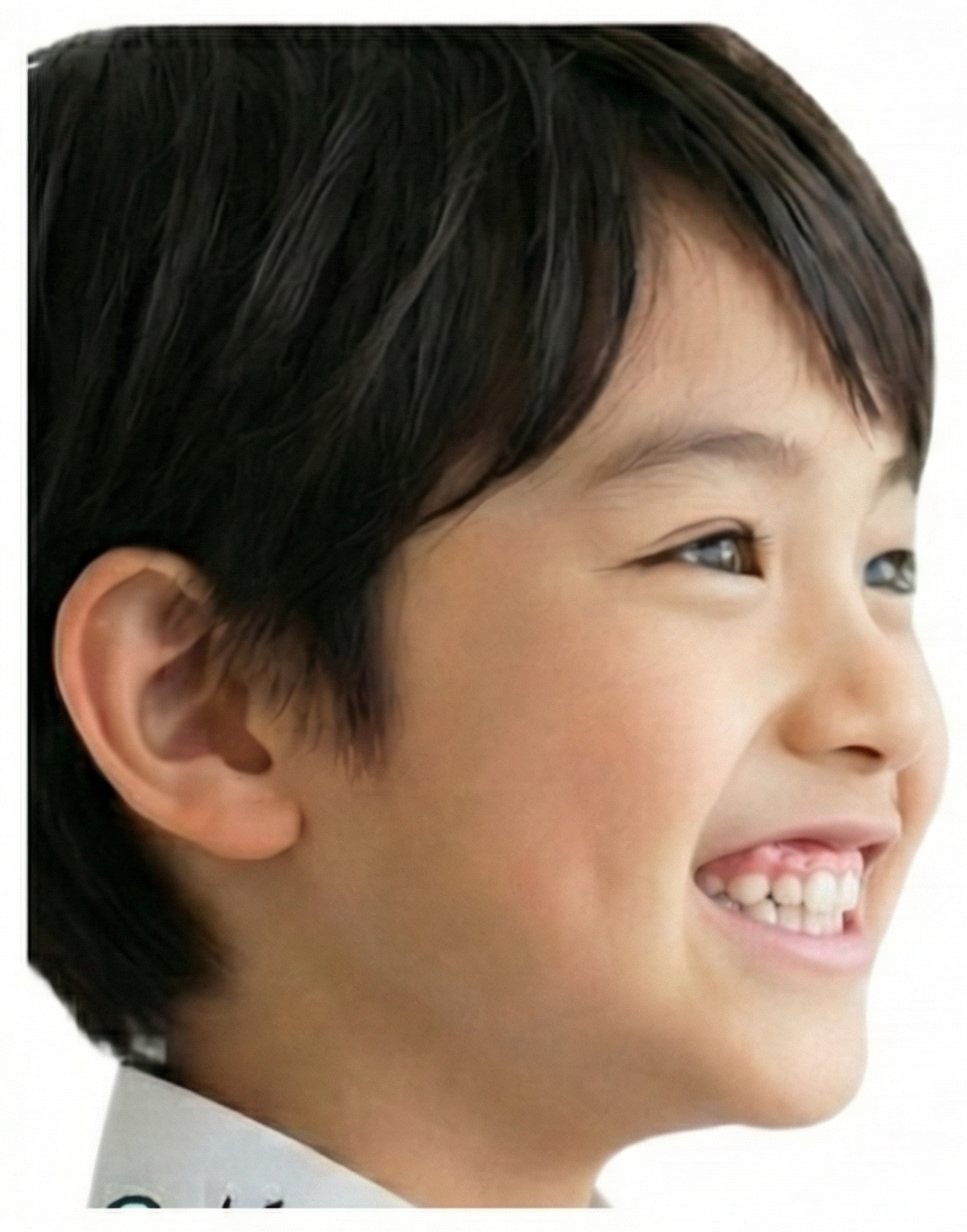 子供のガミースマイル
