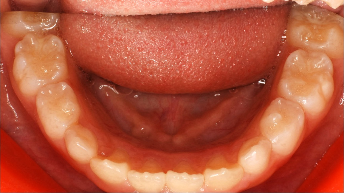 治療後の歯並び