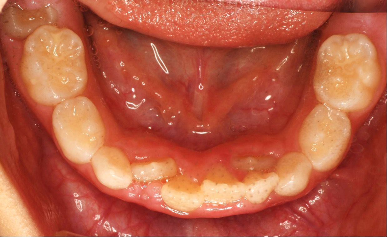 治療前の歯並び